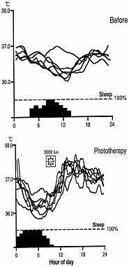 図5　光療法による睡眠と直腸温の変化