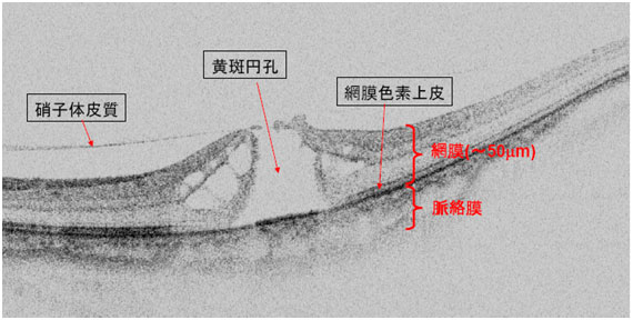 図7　網膜の黄斑部に発生した黄斑円孔のOCT画像