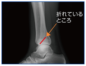 折れているところ